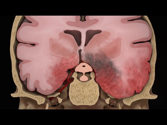 Aneurysm