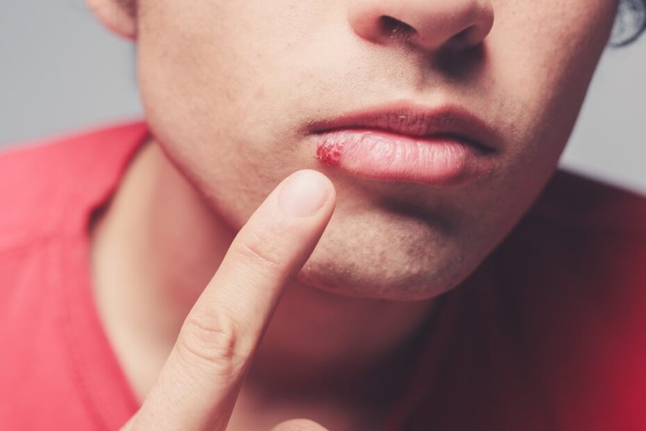 Can you be immune to cold sores