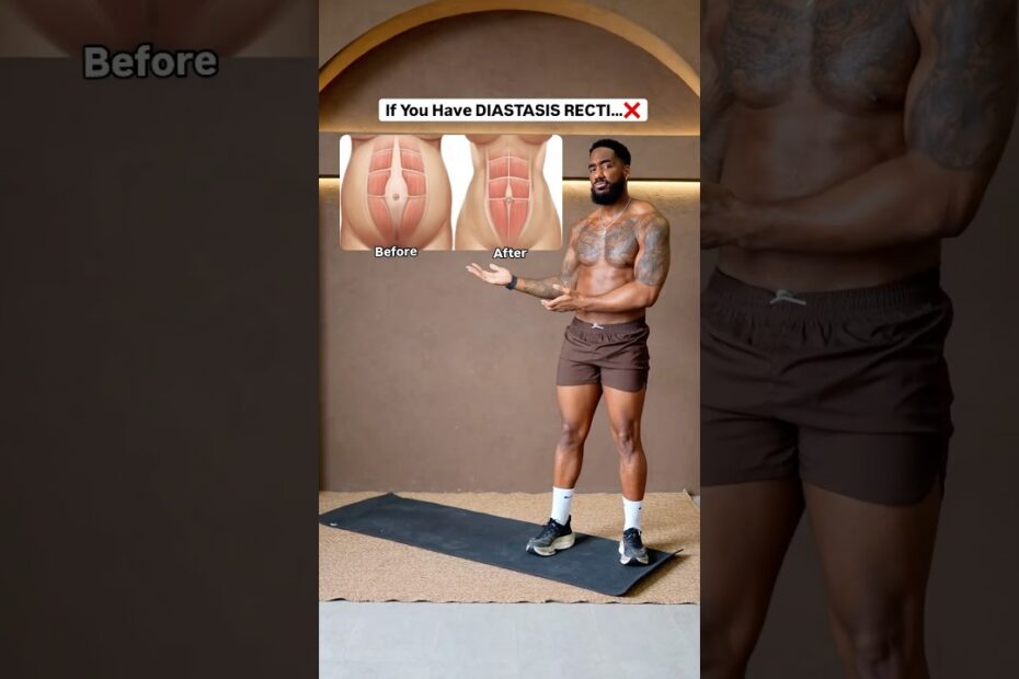 Diastasis recti workout