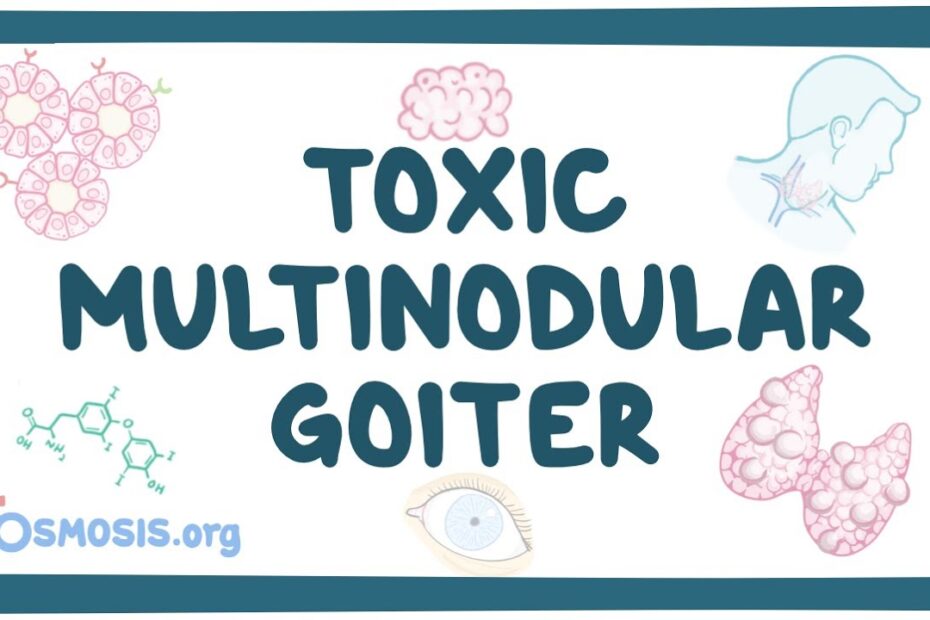 Goiter