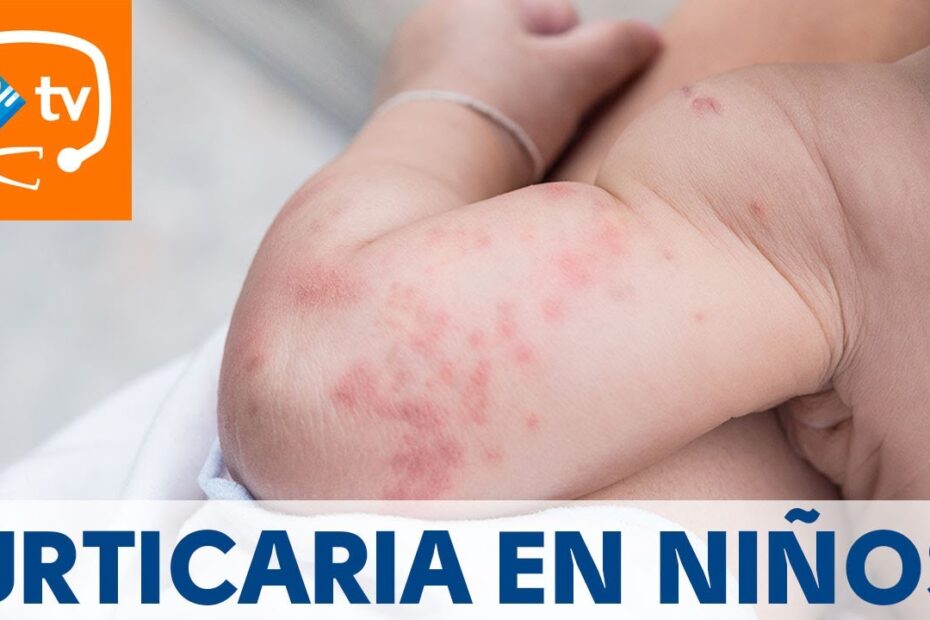 Medicamento para alergias en niños en la piel