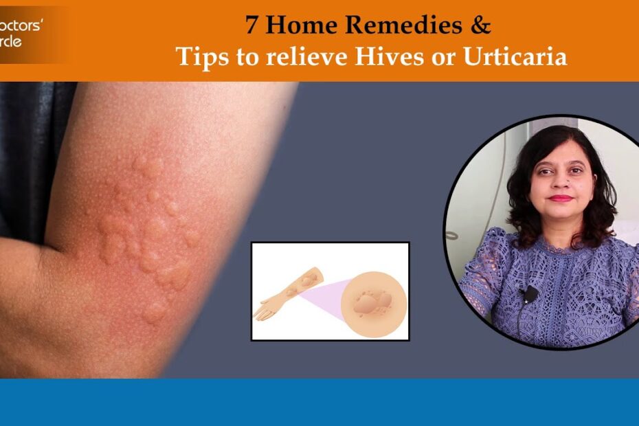 Natural Remedies For Hives