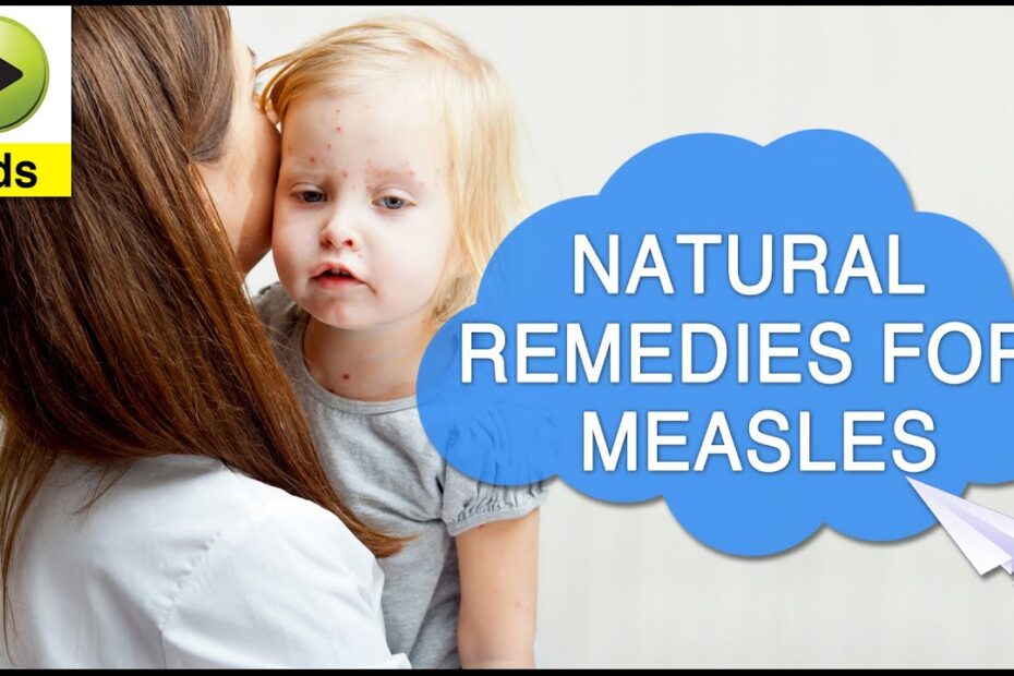 Natural remedies for measles