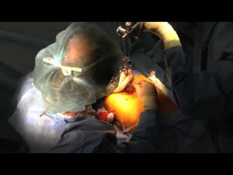 Pectus Excavatum Surgery