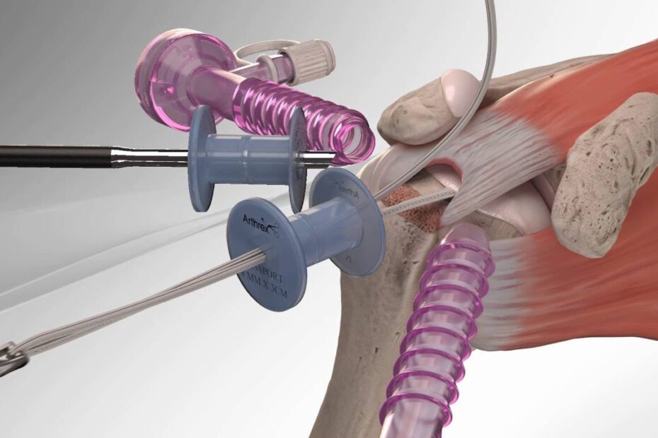Rotator cuff surgery