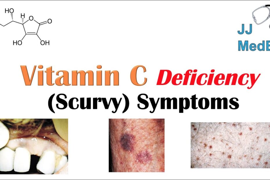 Scurvy symptoms