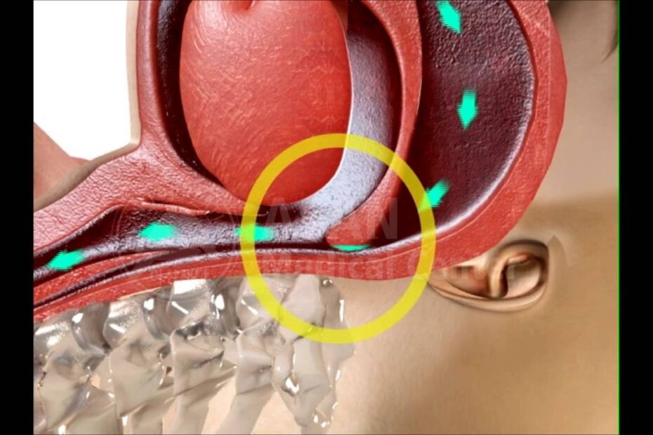 Snoring treatment
