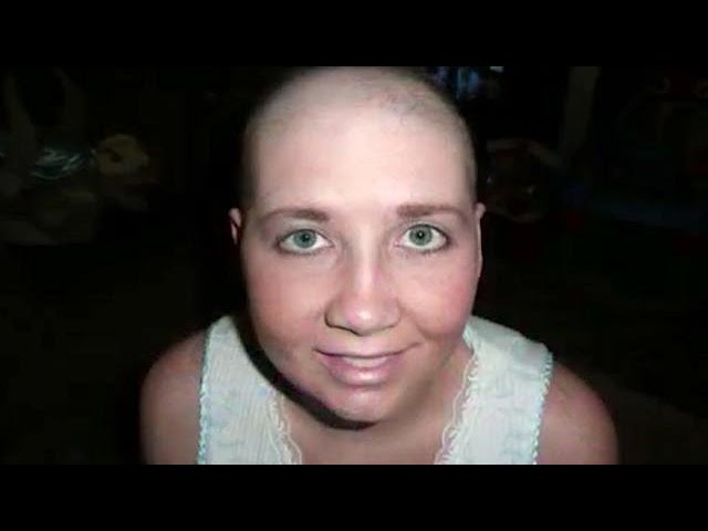 Stage 4 Brain Cancer