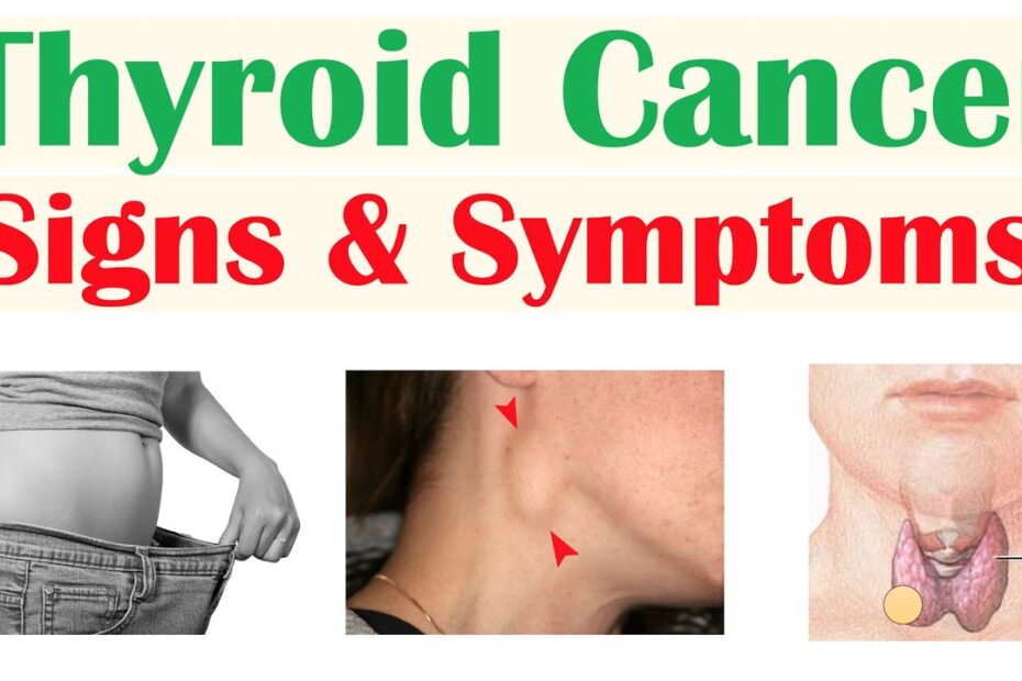 Symptoms of thyroid cancer