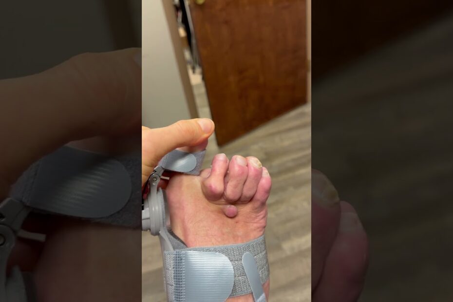 Treatmedy bunion fix