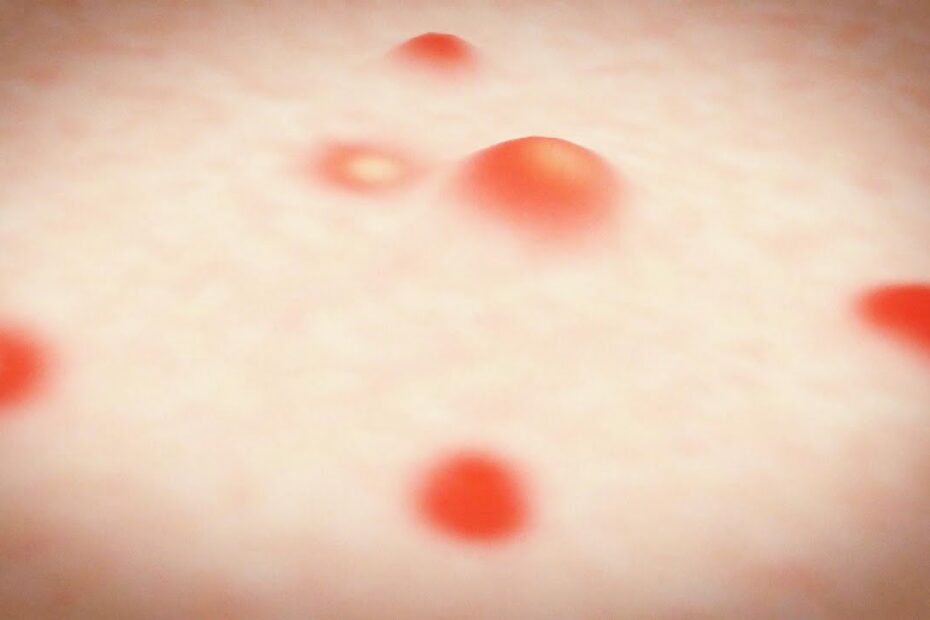 What Is Shingles