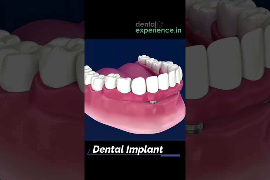 affordable full mouth dental implants