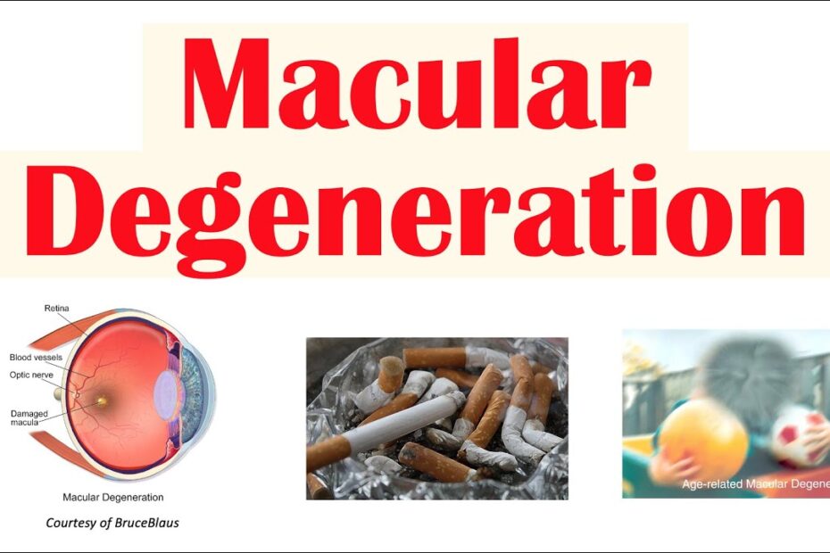 age related macular degeneration overview