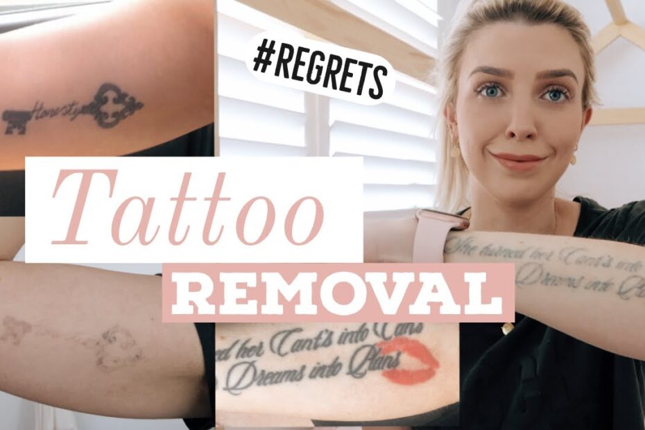 best tattoo removal in houston