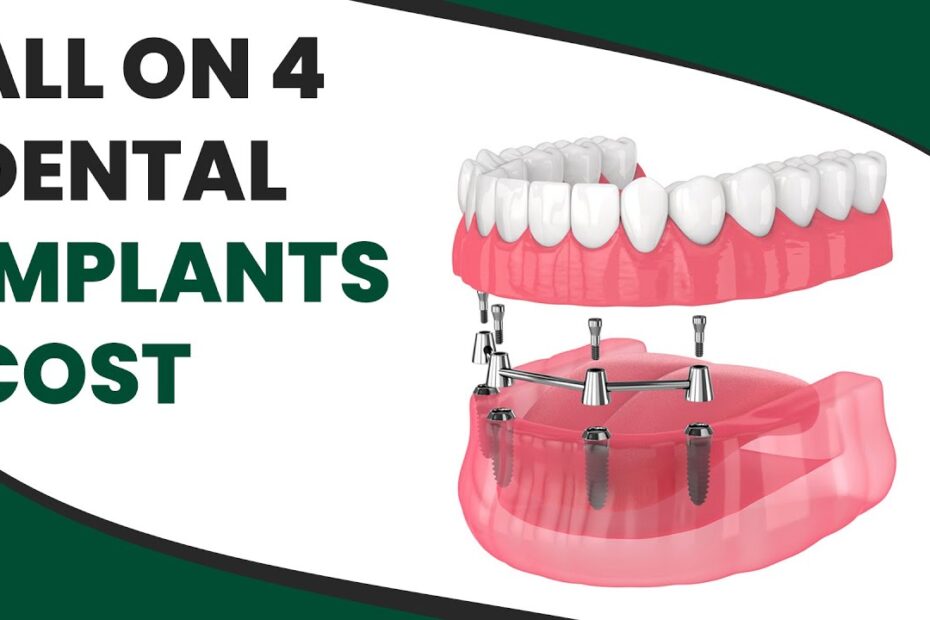 dental implants price
