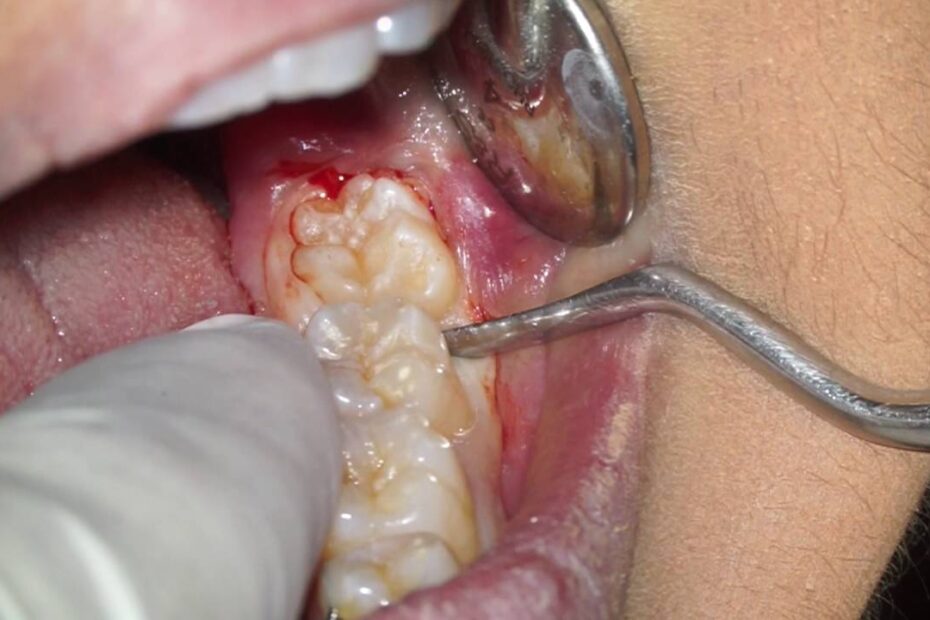 emergency wisdom tooth removal near me