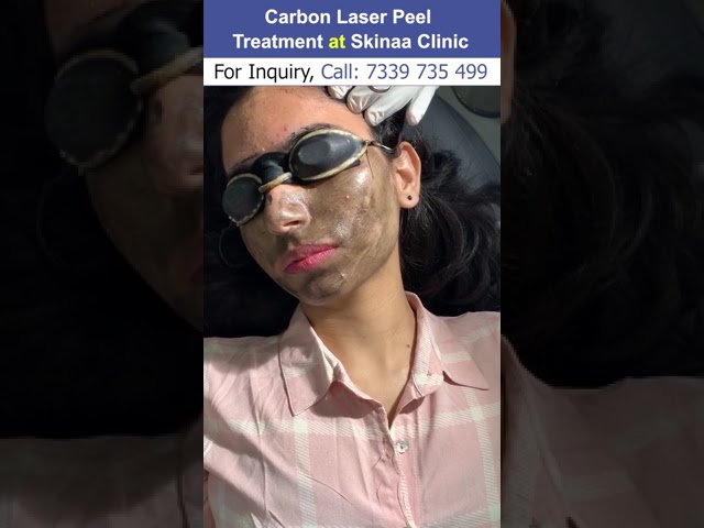 face laser treatment price