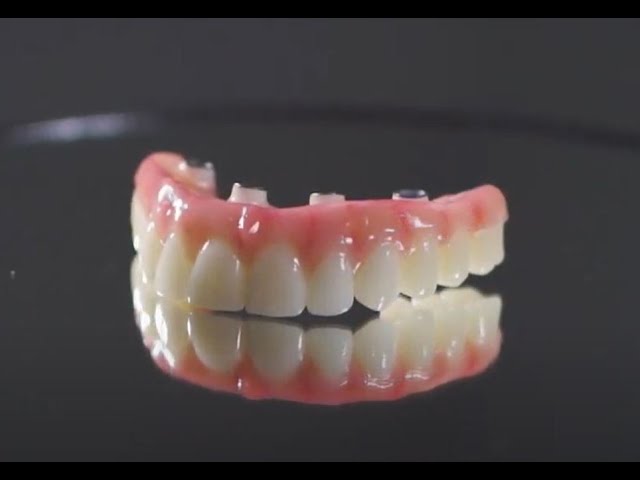 full mouth dental implants