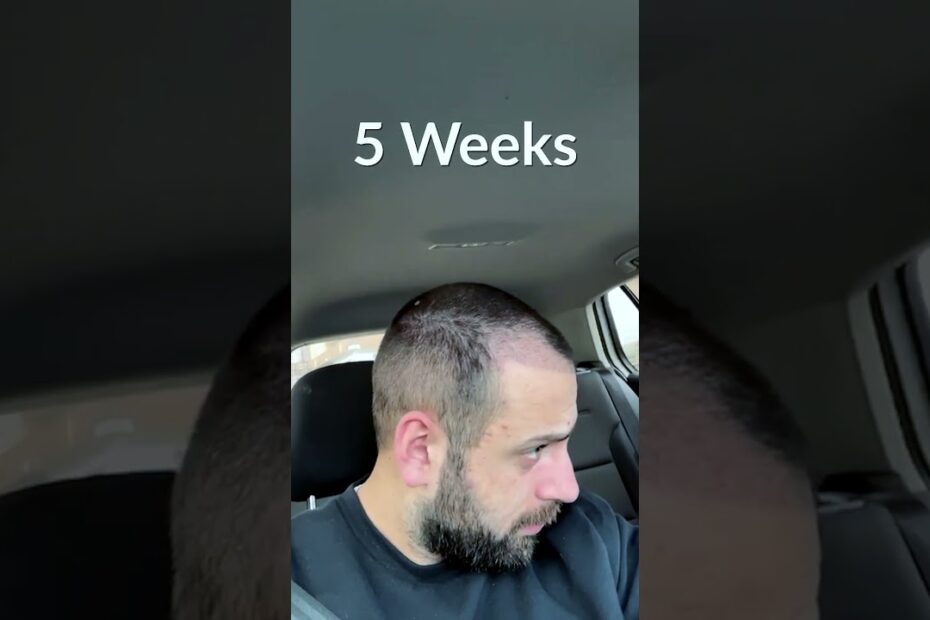 hair replacement system israel