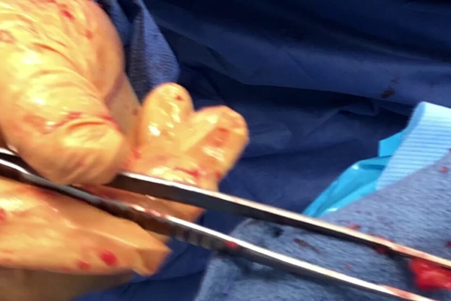 hydrogel injection for breast