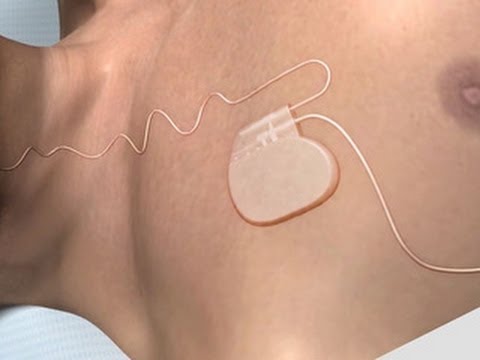 new device for sleep apnea