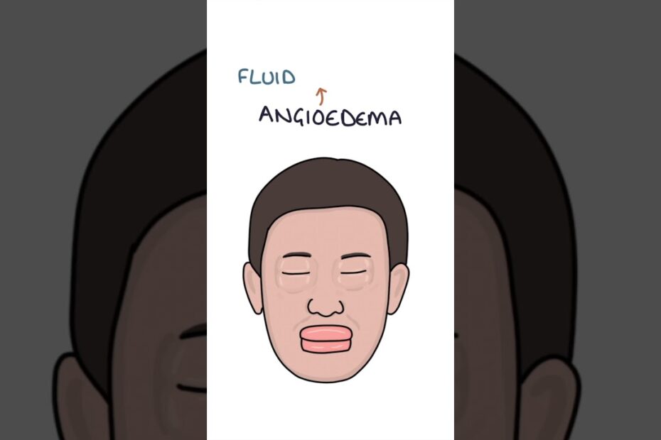 angioedema medication
