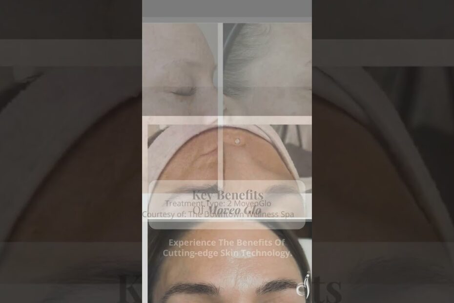 botox paralimni