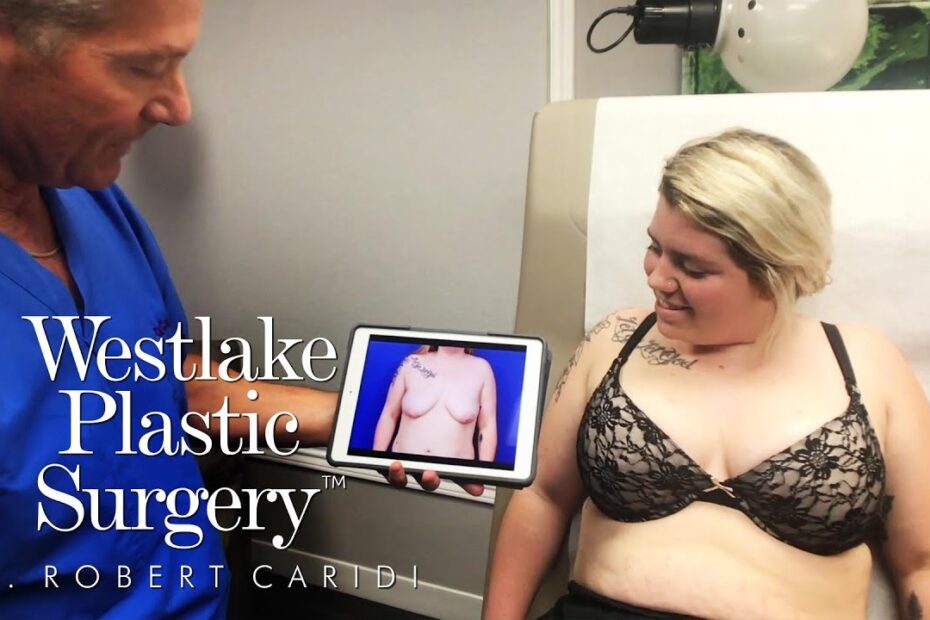Breast Lift and Augmentation Before and After Results That Transform 10 breast lift and augmentation before and after