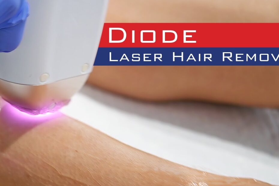 diode laser hair removal machine canada