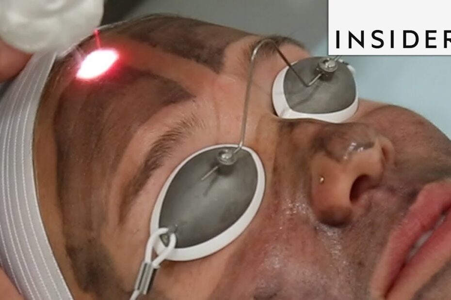 Face Laser Treatment: Achieve Clear, Radiant Skin Now 4 face laser treatment