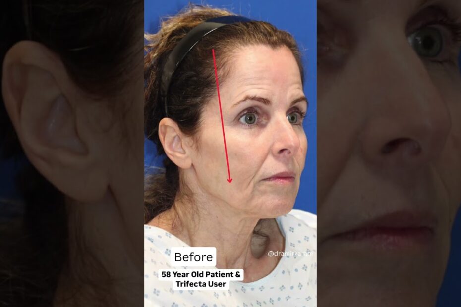 Plastic Surgery to Look Younger: Achieve Timeless Beauty Now 10 plastic surgery to look younger