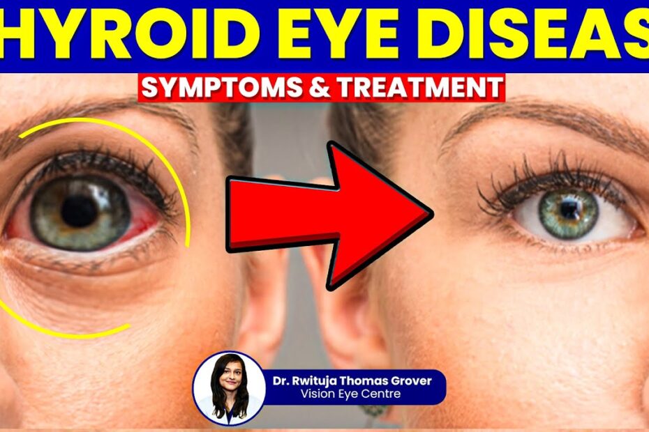 Best Treatment Options for Eye Diseases: A Complete Guide 2 treatment of eye disease